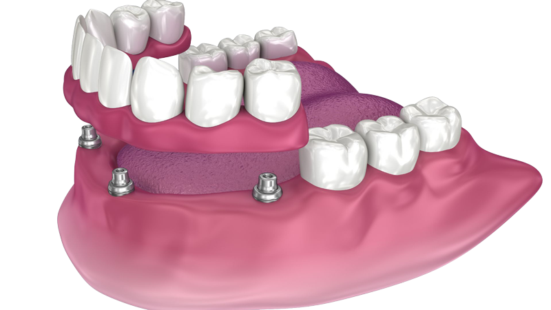 All-On-4-Dental-Implants-1--Perth-Dental