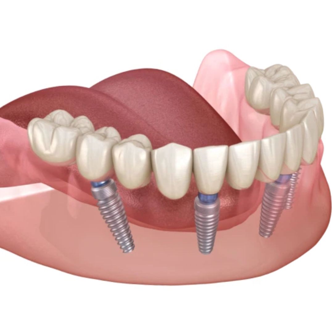 All-on-X-dental-Implant-Stable